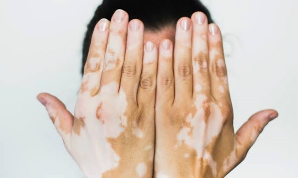 Mewaspadai Gejala Penyakit Autoimun