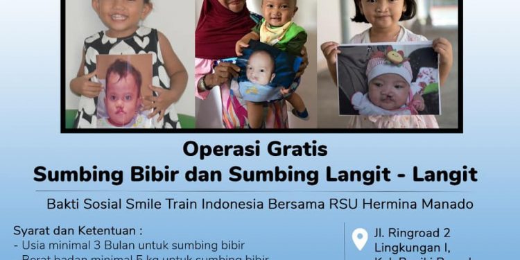 Smile Train Indonesia, RSU Hermina Manado, dan AMSI Sulut Gelar Baksos Operasi Bibir Sumbing